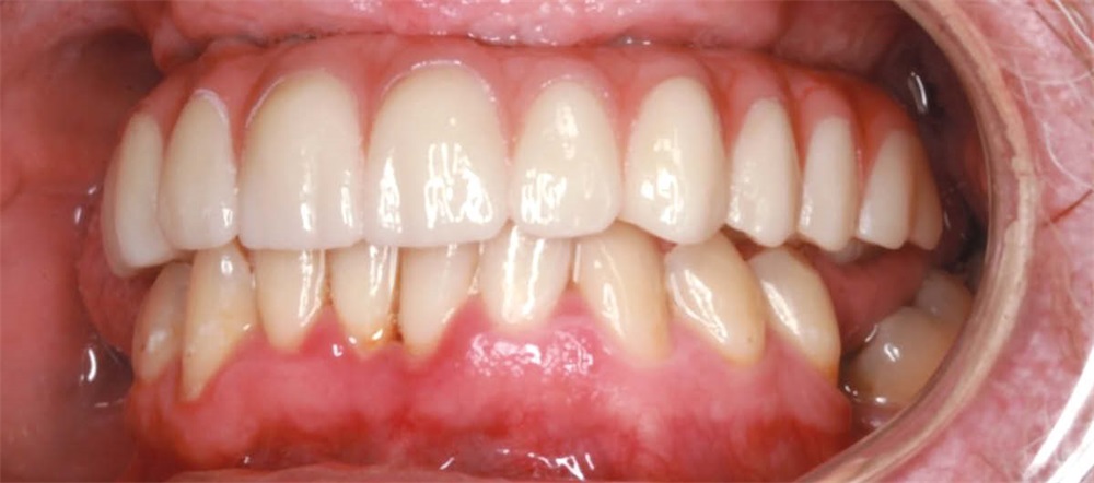 Show Your Work: A Traditional Touch to All-on-X Treatment