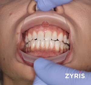 Zyris Retractor