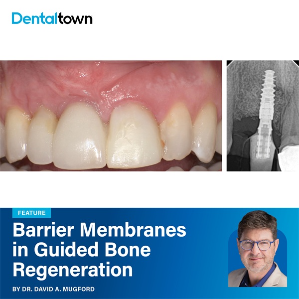 Barrier Membranes in Guided Bone Regeneration