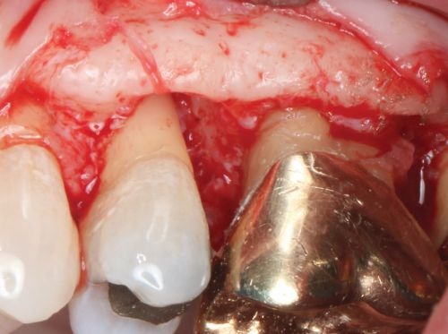 Barrier Membranes in Guided Bone Regeneration