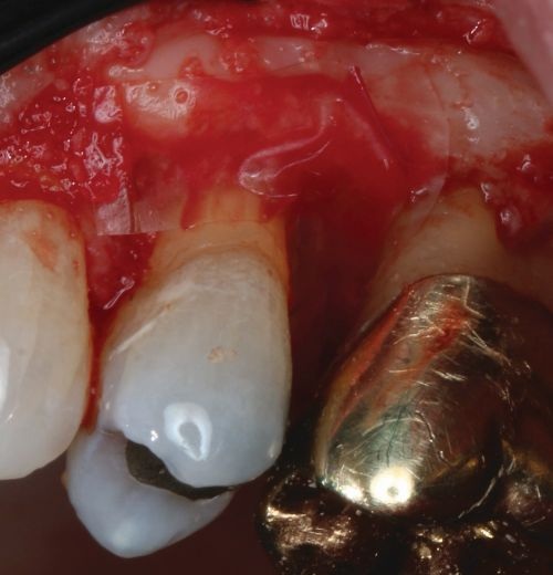Barrier Membranes in Guided Bone Regeneration