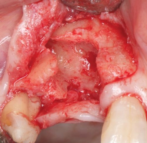 Barrier Membranes in Guided Bone Regeneration
