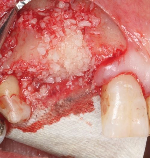 Barrier Membranes in Guided Bone Regeneration