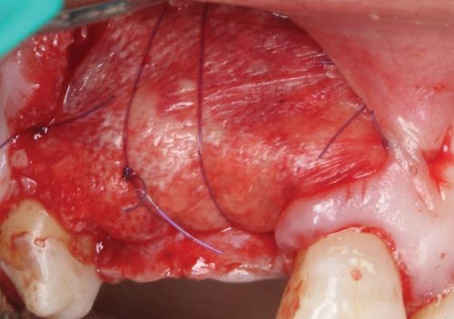 Barrier Membranes in Guided Bone Regeneration