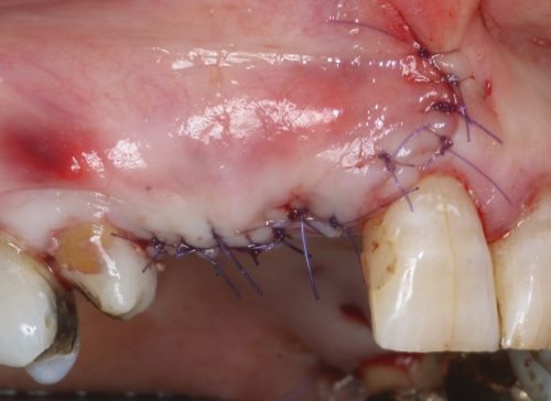 Barrier Membranes in Guided Bone Regeneration