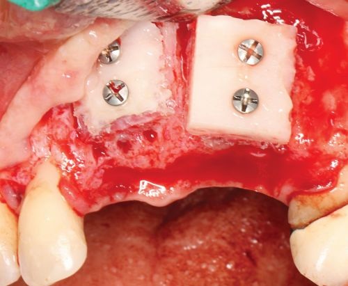 Barrier Membranes in Guided Bone Regeneration
