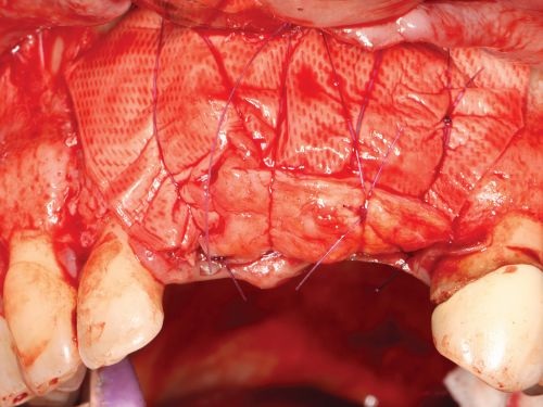 Barrier Membranes in Guided Bone Regeneration