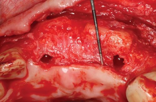 Barrier Membranes in Guided Bone Regeneration