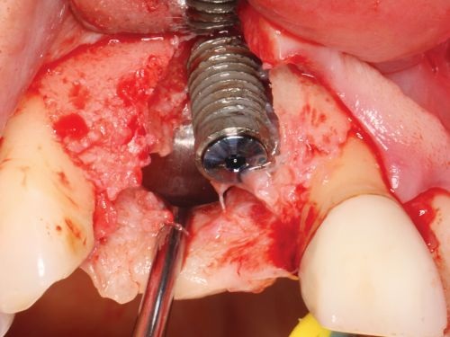 Barrier Membranes in Guided Bone Regeneration