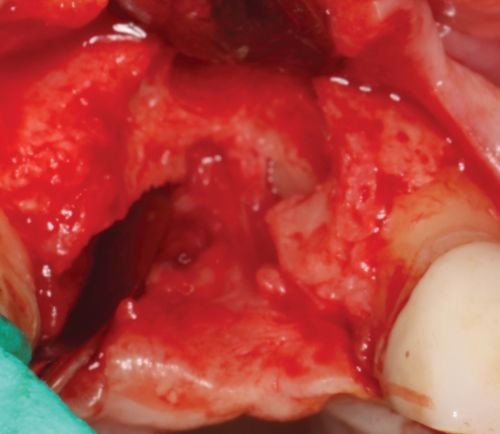 Barrier Membranes in Guided Bone Regeneration