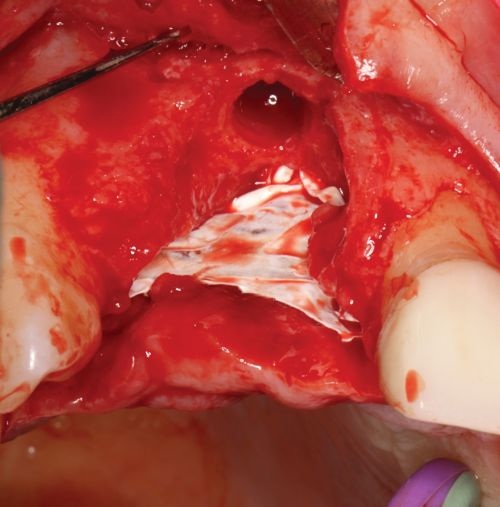 Barrier Membranes in Guided Bone Regeneration