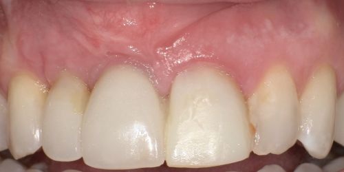 Barrier Membranes in Guided Bone Regeneration