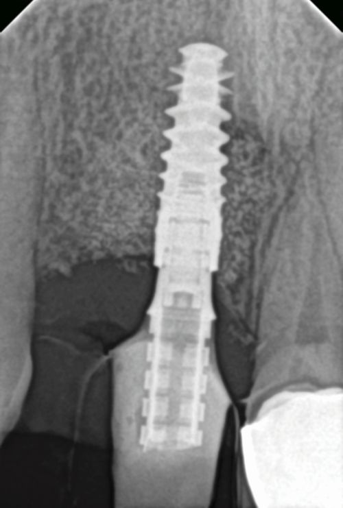 Barrier Membranes in Guided Bone Regeneration