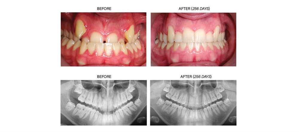 Product Profile: Fastbraces