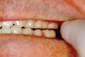 CE: The Essential Try-In Acceptance Appointment