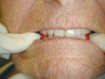 CE: The Essential Try-In Acceptance Appointment