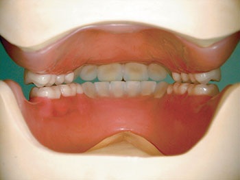 CE: The Essential Try-In Acceptance Appointment