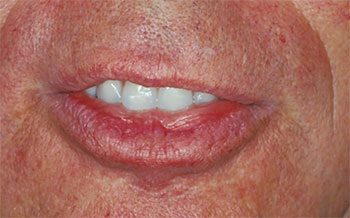 CE: The Essential Try-In Acceptance Appointment