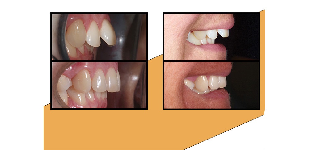 Dr Salman Siddiqi shares an anterior alignment orthodontic case