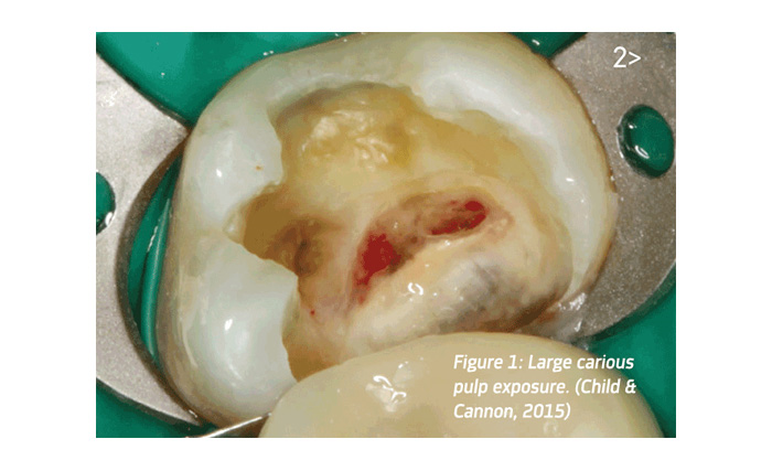 Dentaltown UK Magazine- Figure 1: Large carious pulp exposure. (Child & Cannon, 2015)