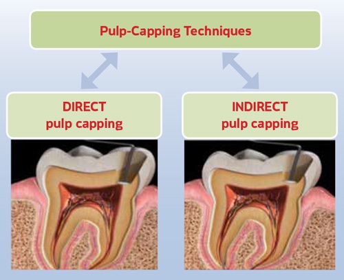 Figure 3: Image from Shekhar Star. Illustration showing that direct pulp caps are placed over exposed pulpal tissue. It is essential to get good haemostasis and ensure moisture control is optimal before placing any medicament. Indirect pulp caps are placed over residual caries or remaining tooth structure.