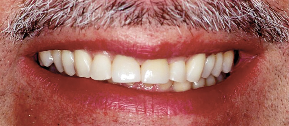 Show Your Work: Minimally Restoring Severe Tooth Surface Loss