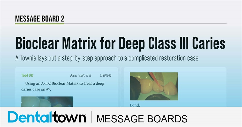 Bioclear Matrix for Deep Class III Caries