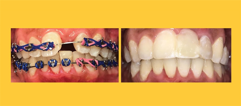 Product Profile: Fastbraces