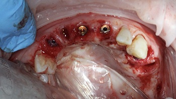 Clinical Case Spotlight: Using the Isolite Pro to Simplify a Full-Arch Implant Case