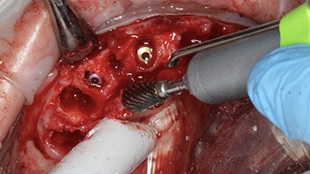 Clinical Case Spotlight: Using the Isolite Pro to Simplify a Full-Arch Implant Case