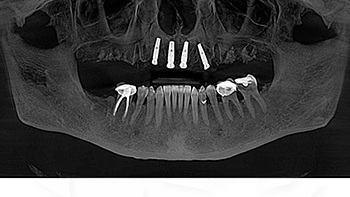 Clinical Case Spotlight: Using the Isolite Pro to Simplify a Full-Arch Implant Case