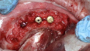 Clinical Case Spotlight: Using the Isolite Pro to Simplify a Full-Arch Implant Case