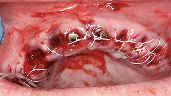 Clinical Case Spotlight: Using the Isolite Pro to Simplify a Full-Arch Implant Case