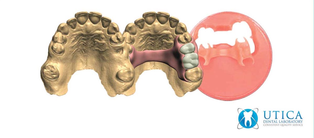 TCS 3D Flexible Partials