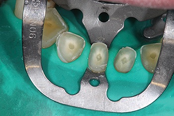 Townie Casefile: A Freehand Composite Rehab