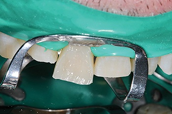 Townie Casefile: A Freehand Composite Rehab