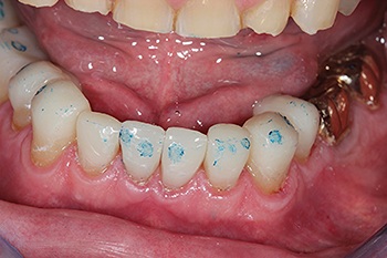 Townie Casefile: A Freehand Composite Rehab