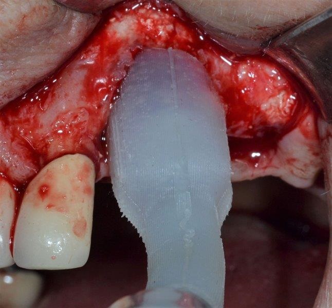 Ultrasonic Cavitation and Peri-Implantitis