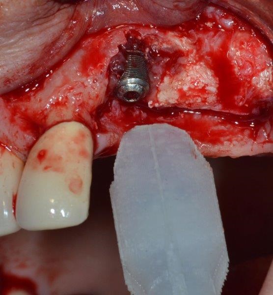 Ultrasonic Cavitation and Peri-Implantitis