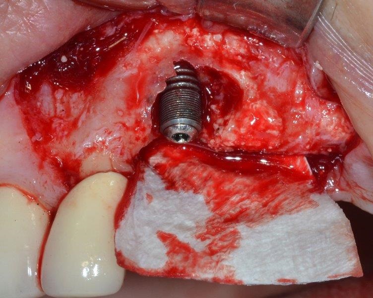Ultrasonic Cavitation and Peri-Implantitis