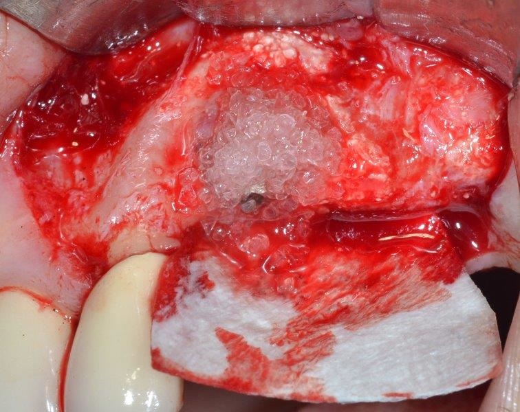 Ultrasonic Cavitation and Peri-Implantitis