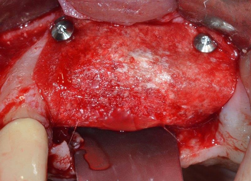 Ultrasonic Cavitation and Peri-Implantitis