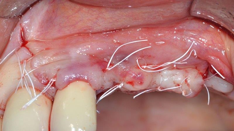 Ultrasonic Cavitation and Peri-Implantitis