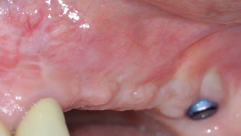 Ultrasonic Cavitation and Peri-Implantitis