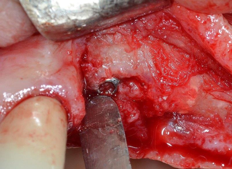 Ultrasonic Cavitation and Peri-Implantitis