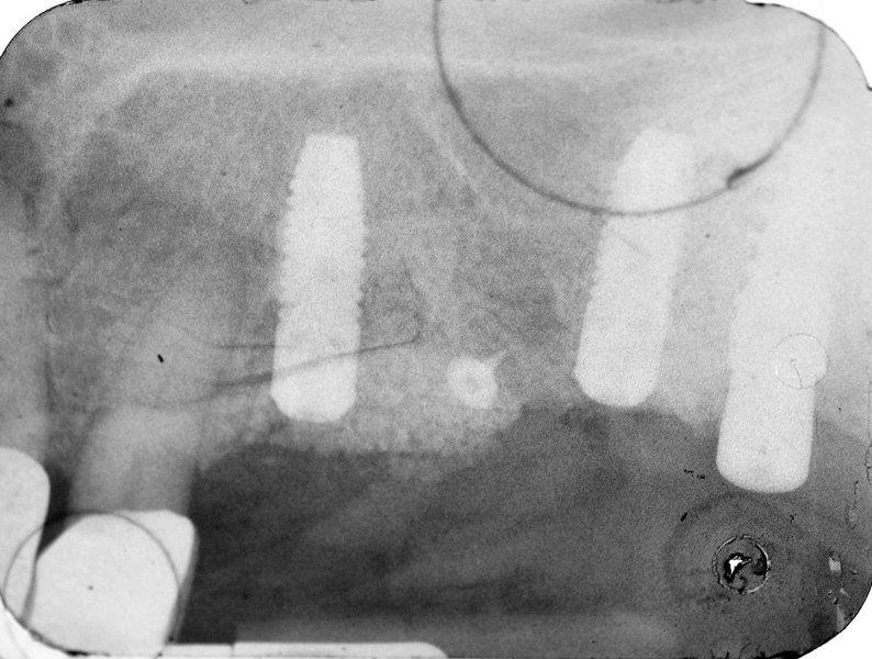 Ultrasonic Cavitation and Peri-Implantitis