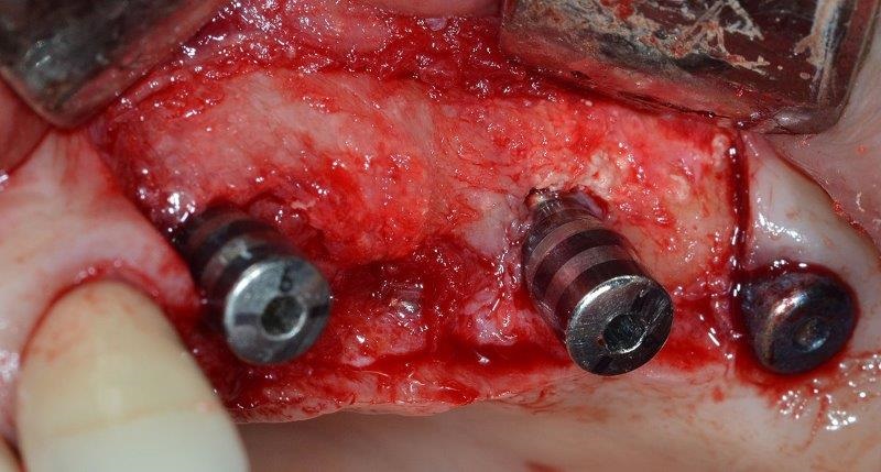 Ultrasonic Cavitation and Peri-Implantitis