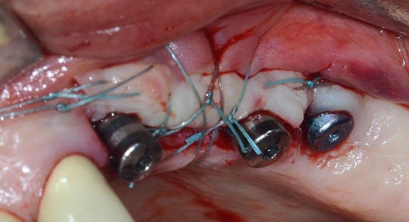 Ultrasonic Cavitation and Peri-Implantitis