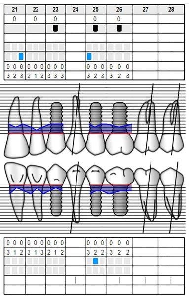 Ultrasonic Cavitation and Peri-Implantitis