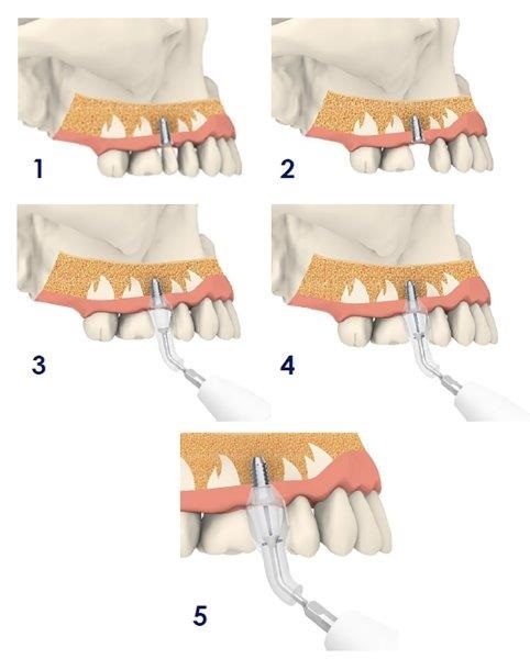 Ultrasonic Cavitation and Peri-Implantitis